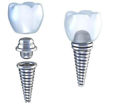 procedimiento de implante dental | xmystool.com